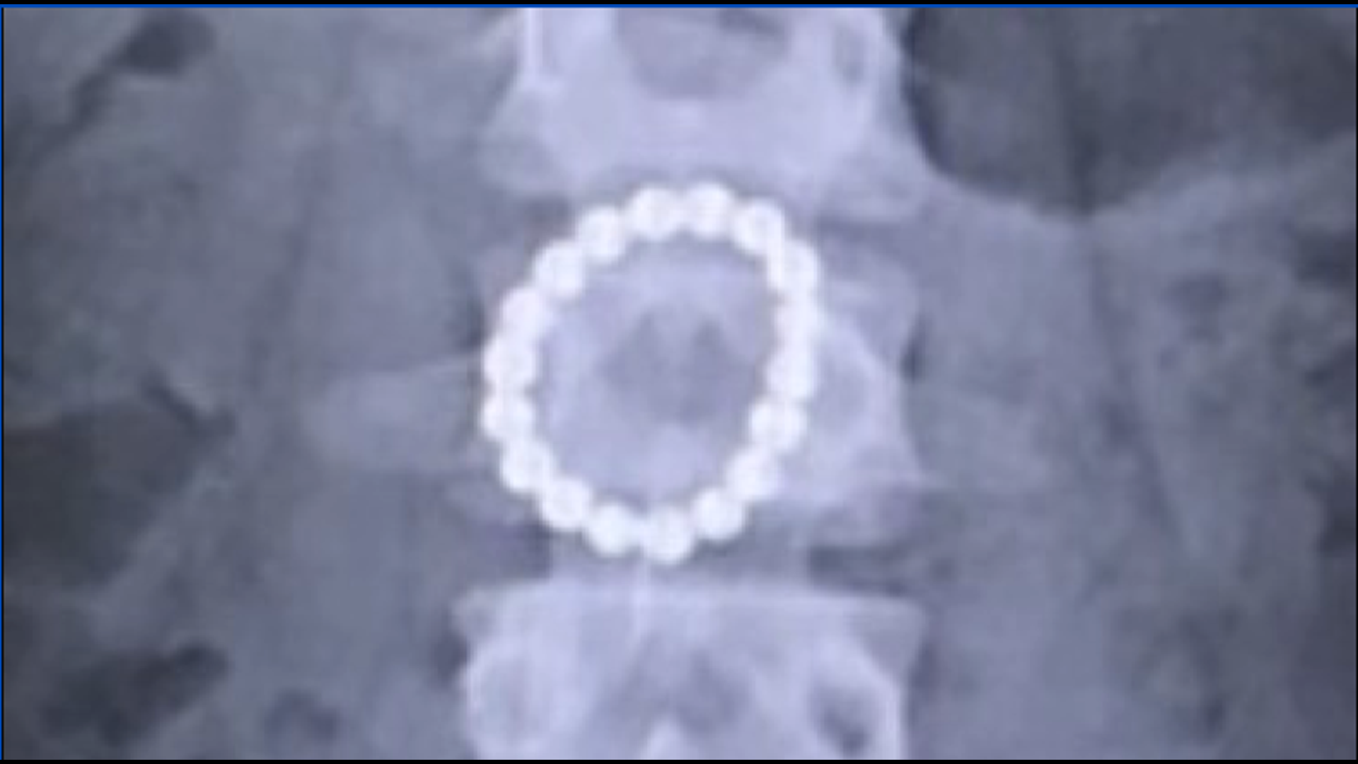 Little magnets are a big health hazard when swallowed