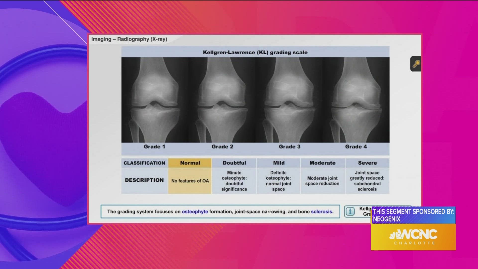 NeoGenix now offering a free knee consultation