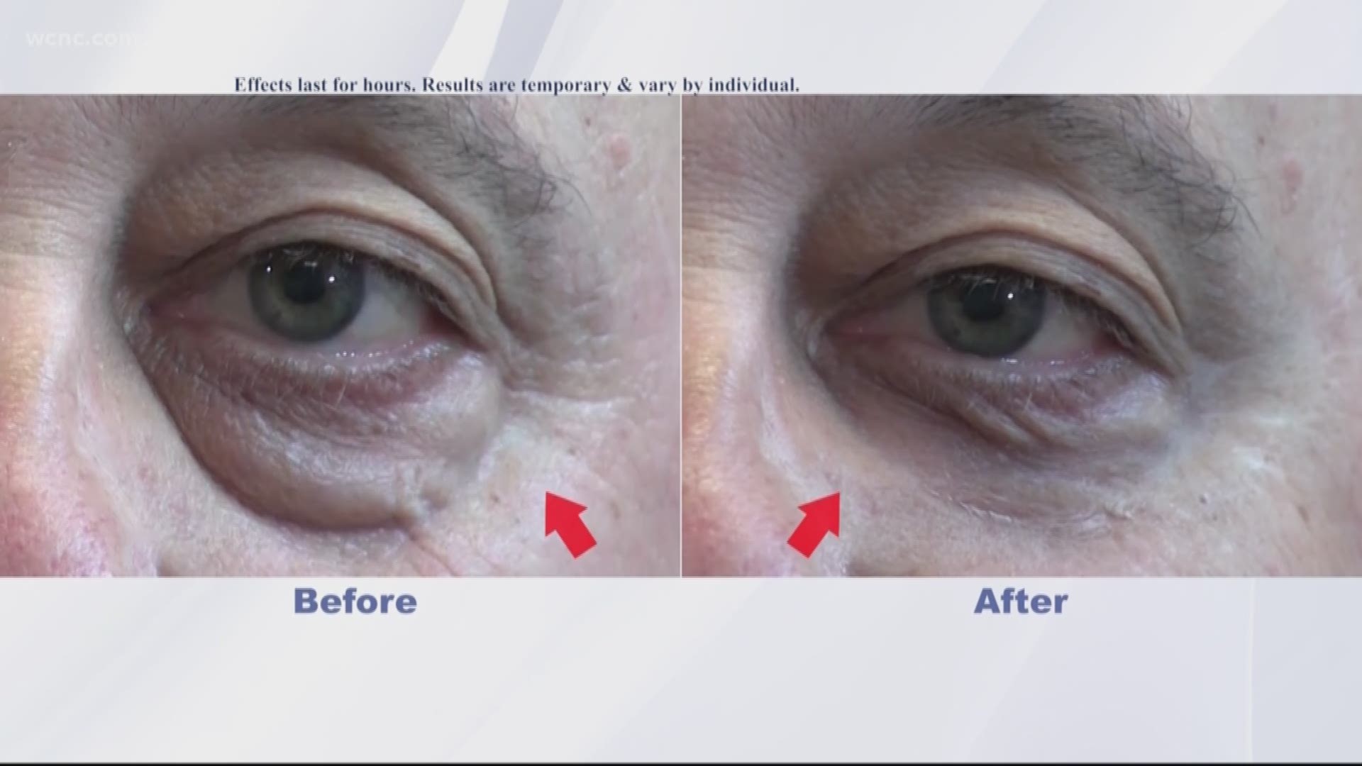 Plexaderm is a revolutionary product that decreases wrinkles and puffiness in minutes for a brighter, younger look.