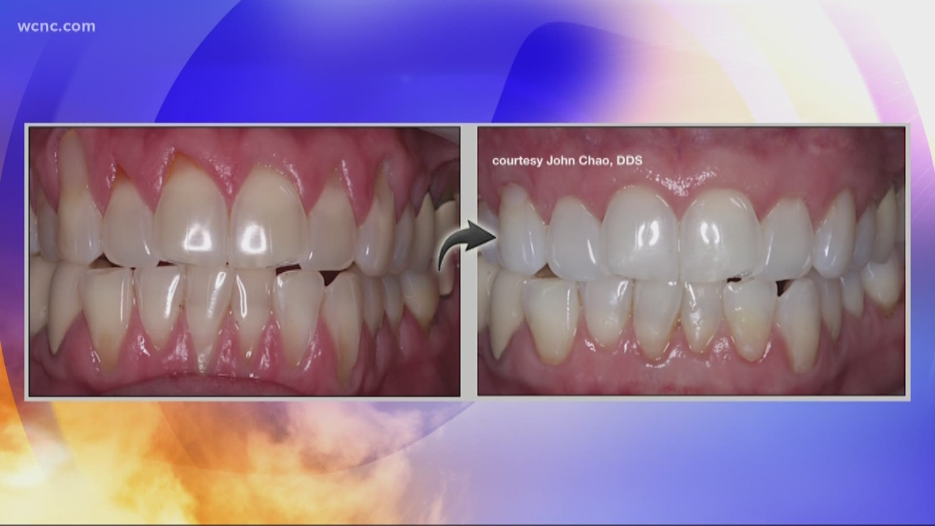 Dr. Chris Bowman from Advanced Dentistry of Charlotte tells us about Chao Pinhole Gum Rejuvenation