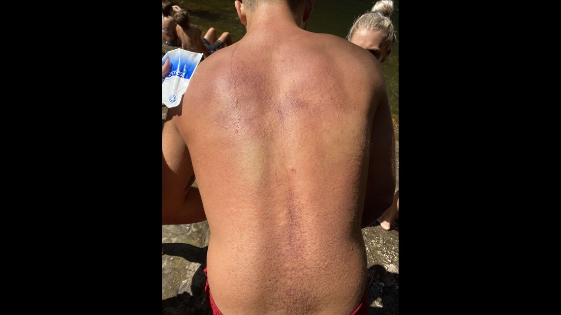 Well folks. I'm out. Be careful doing flips into pool. Broken vertebrae in  neck and 2 broken in my back. : r/Neverbrokeabone