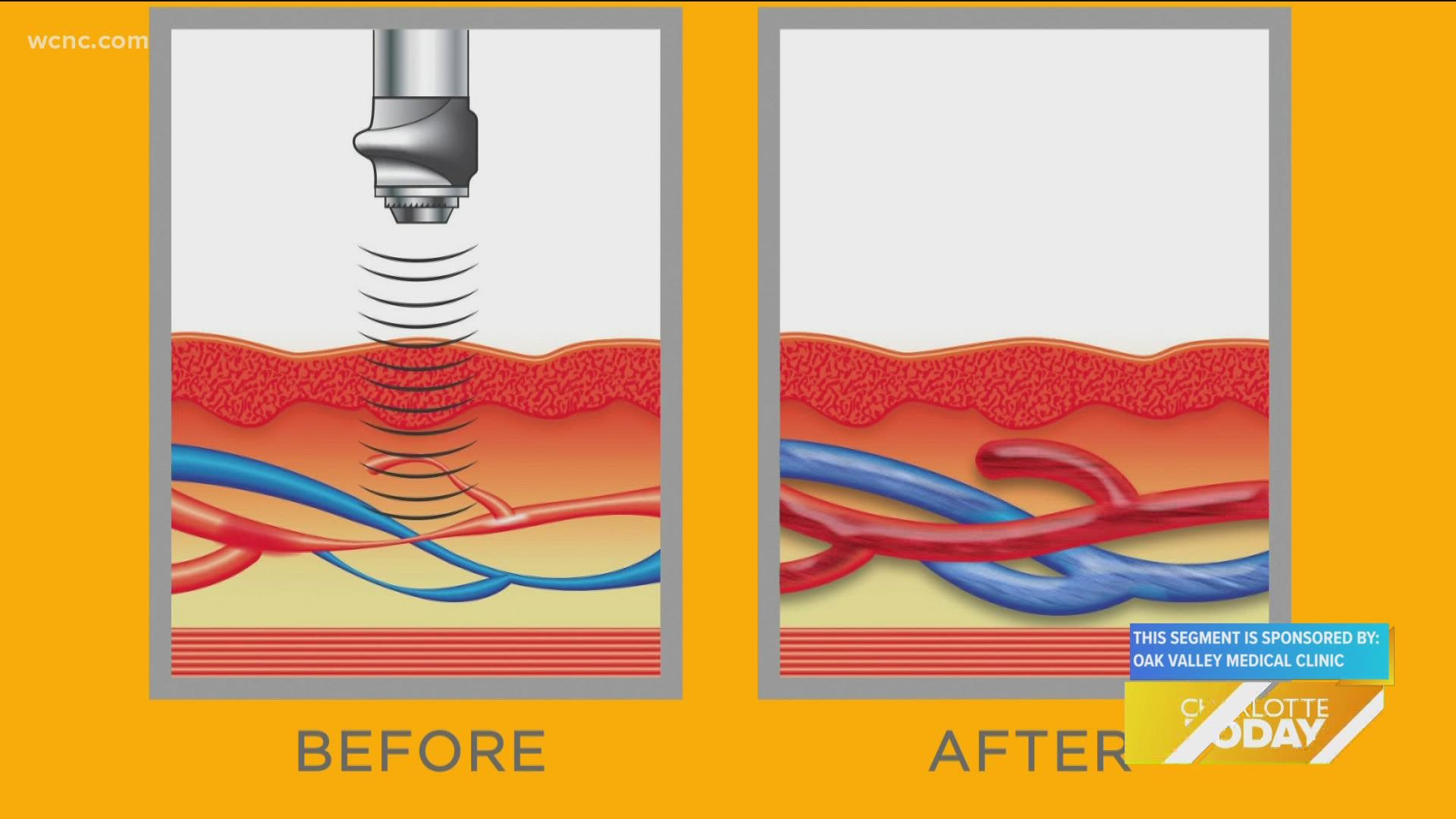 Treat E.D with Acoustic Wave therapy