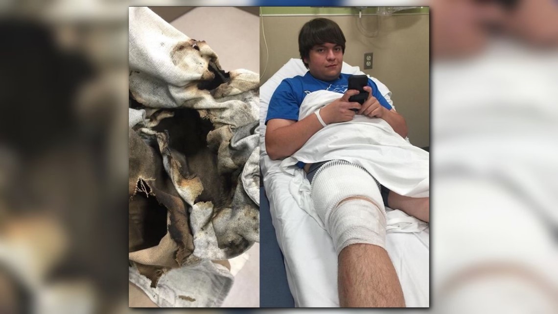 Teen severely burned when e-cigarette batteries explode in pocket ...