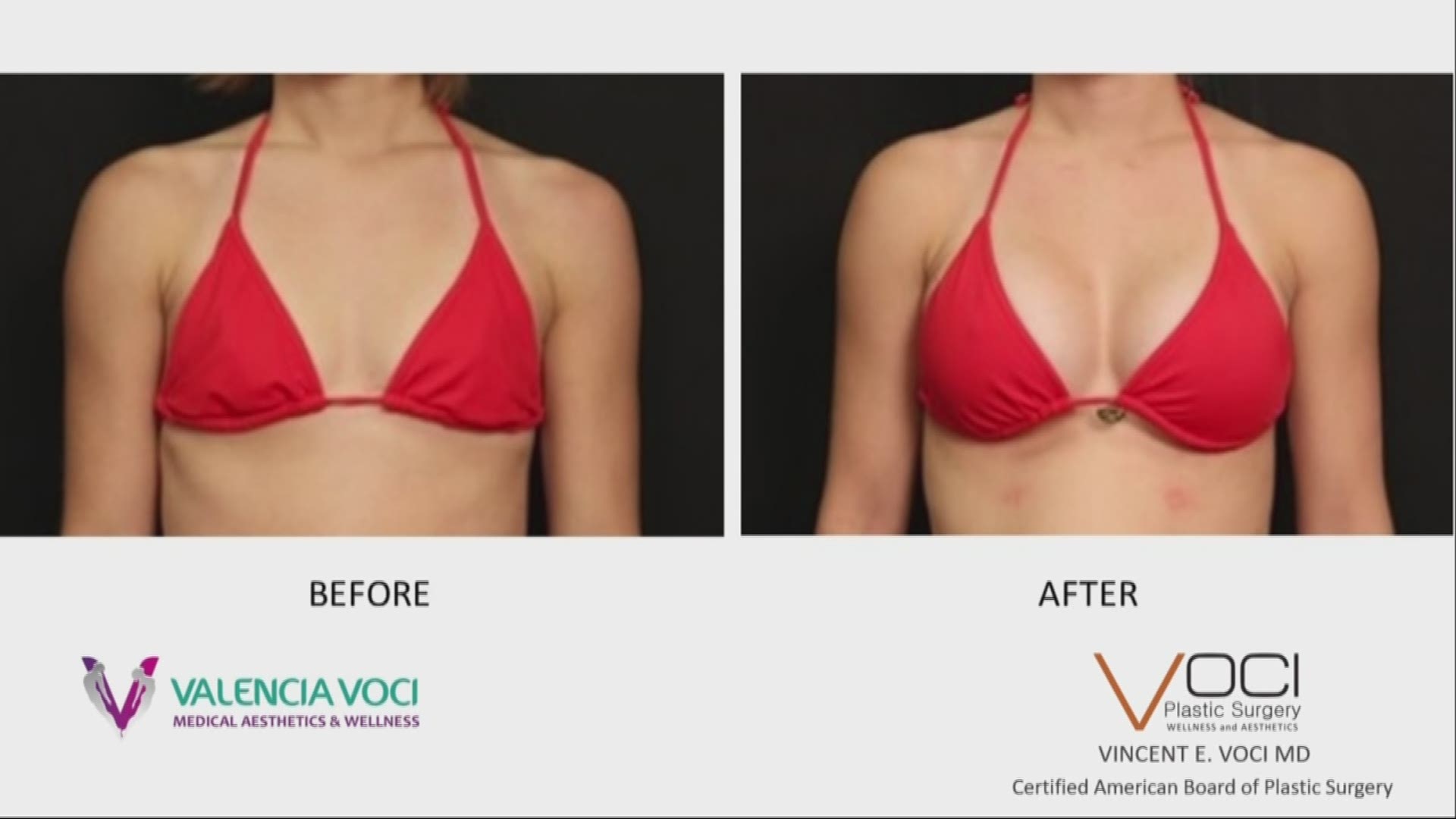 Dr. Vincent Voci talks about why women get cosmetic surgery like breast augmentation and how to choose the right options.