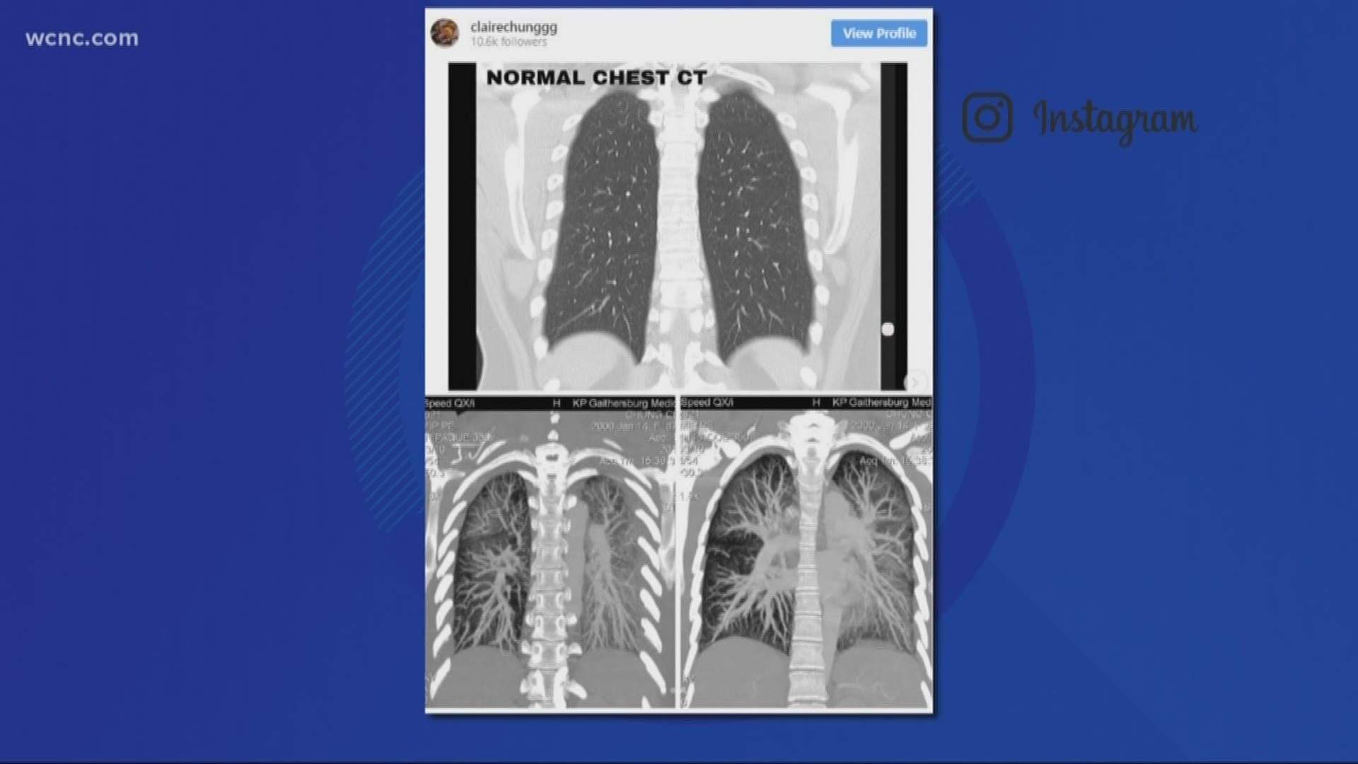 The teenager posted alleged pictures of CT scans that showed the negative effects of vaping.