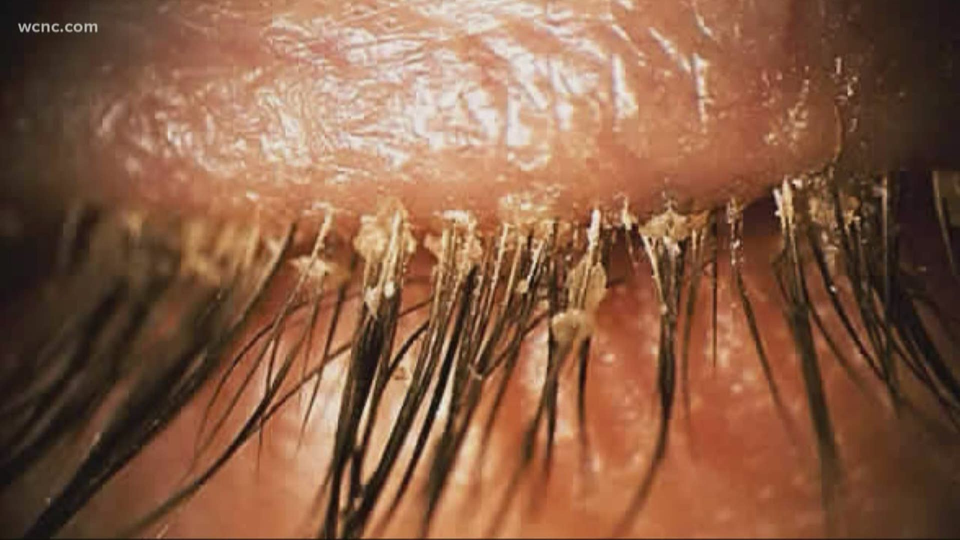 Many women are getting eyelash extensions from technicians that apply lash by lash. But now, some optometrists say they're seeing an increase of tiny mites.