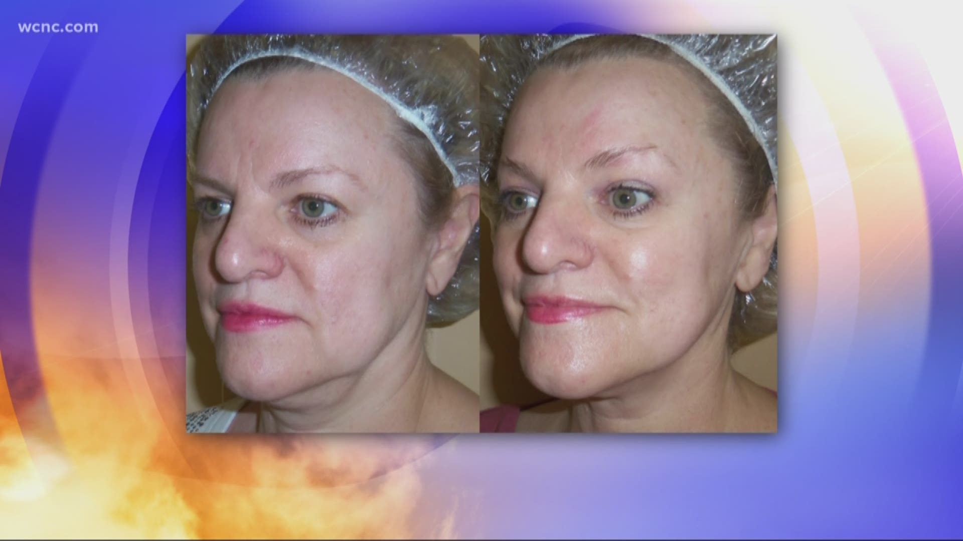 Beautiful Image Anti-Aging specializes in this procedure that turns back the hands of time