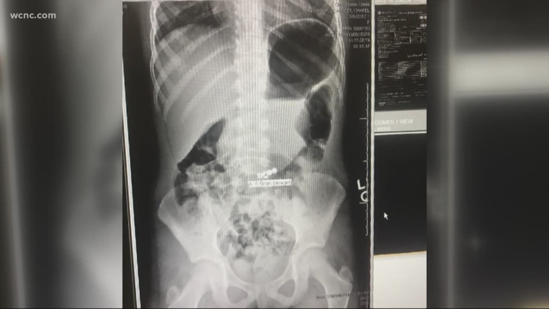 7-year-old gets emergency surgery after swallowing magnetic beads