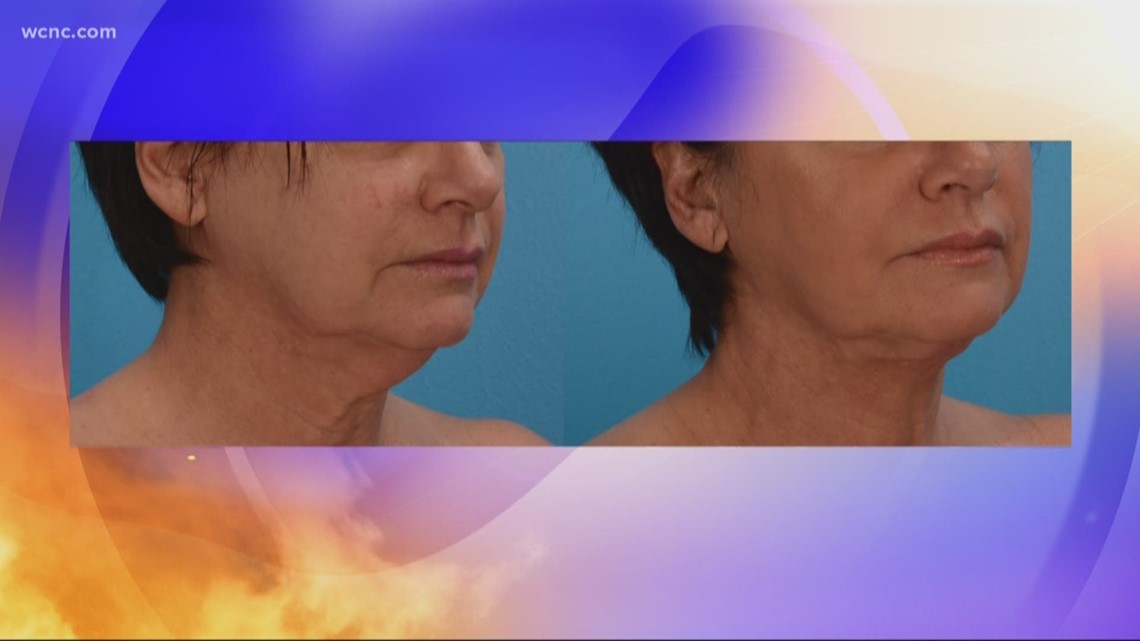Nonsurgical face lifts