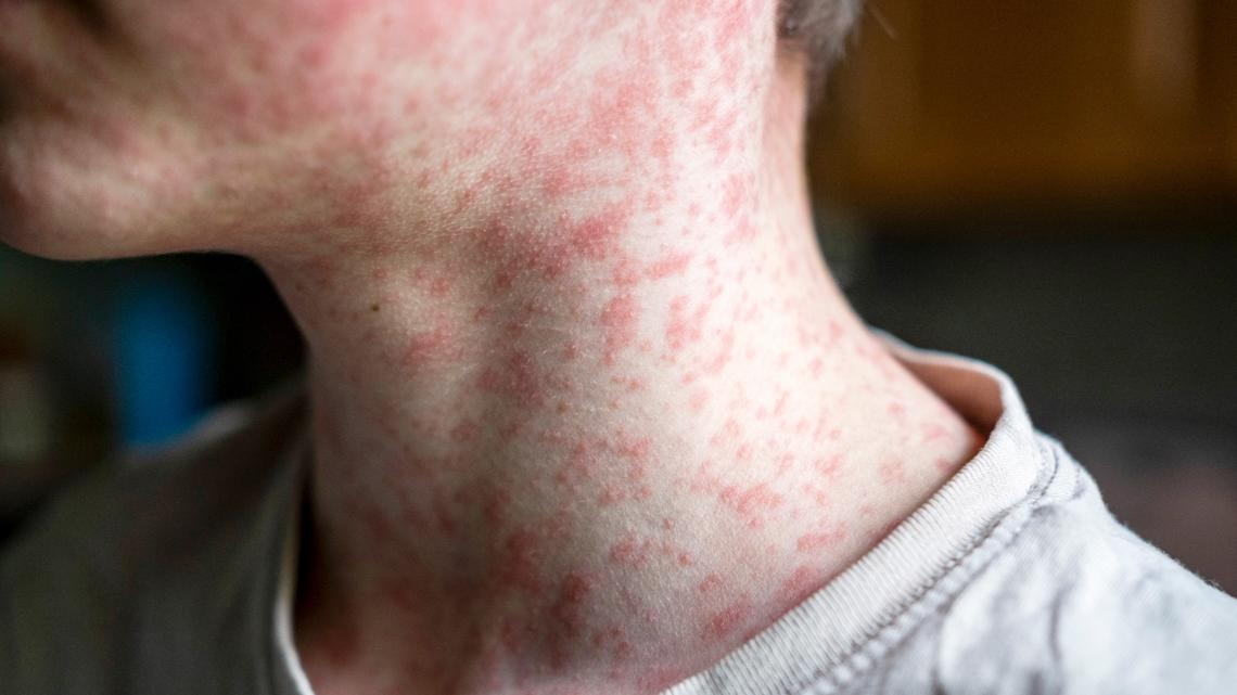 Health officials warn of possible measles exposure at Gastonia restaurant
