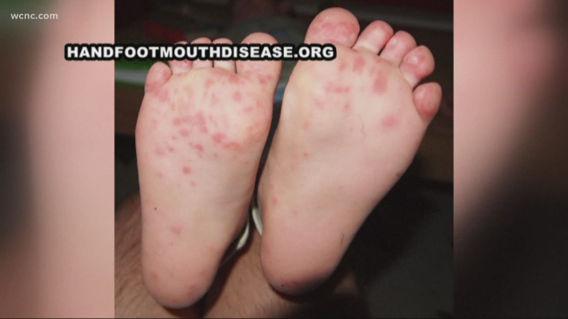 Doctors in South Carolina are seeing cases of hand, foot and mouth disease.