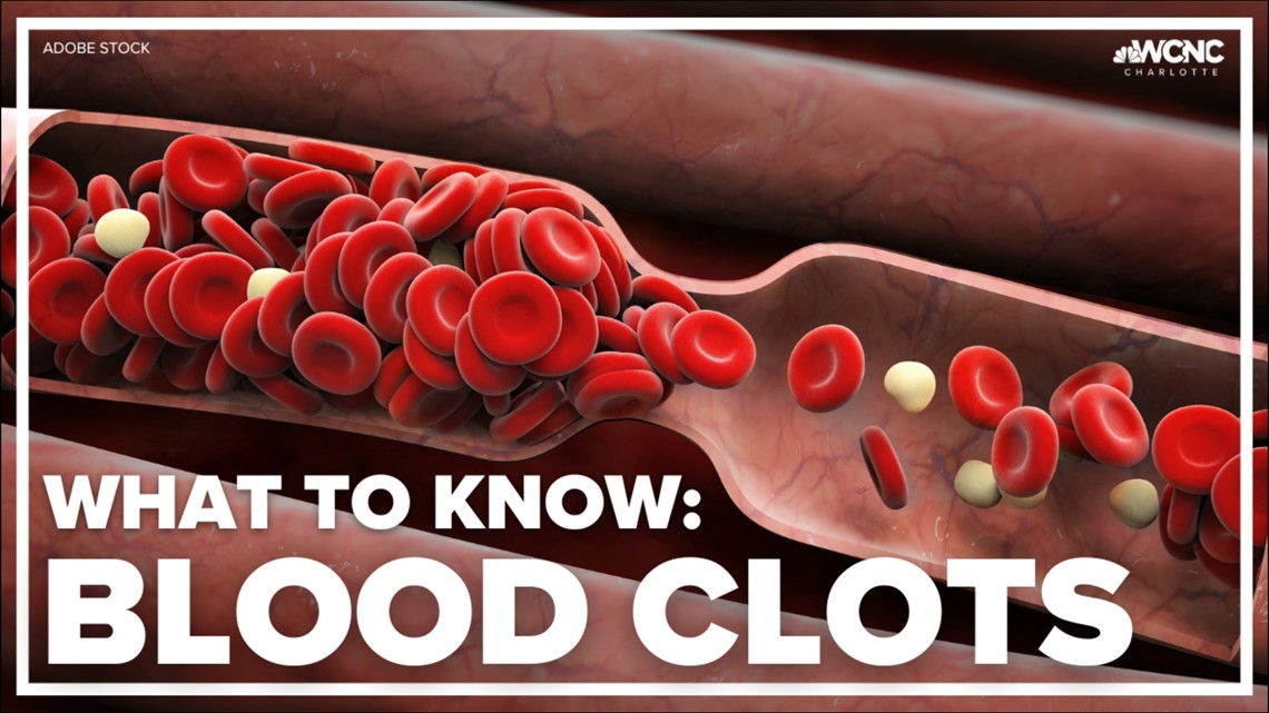 VERIFY What you need to know about blood clots