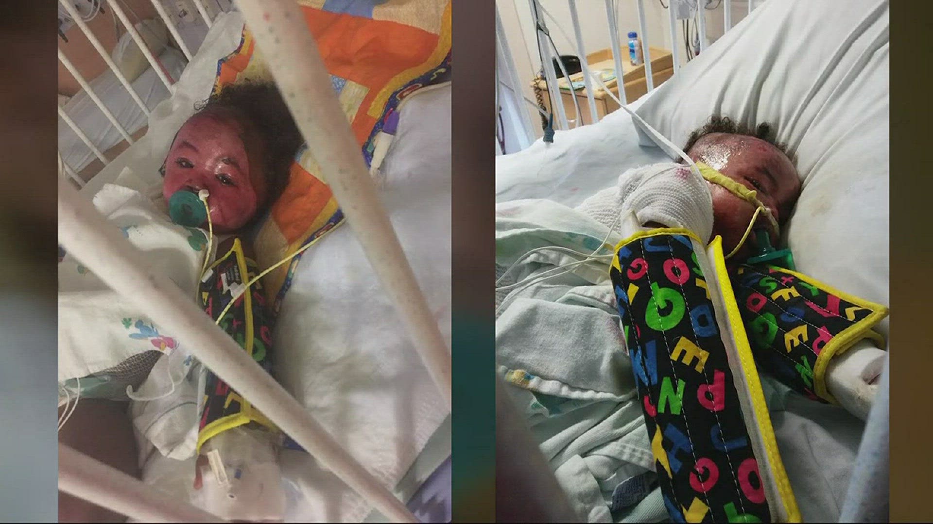 1-year-old baby King tried to grab a hot cup of water from the counter, thinking it was juice. The water spilled onto his body, severely burning his face, chest, and back.