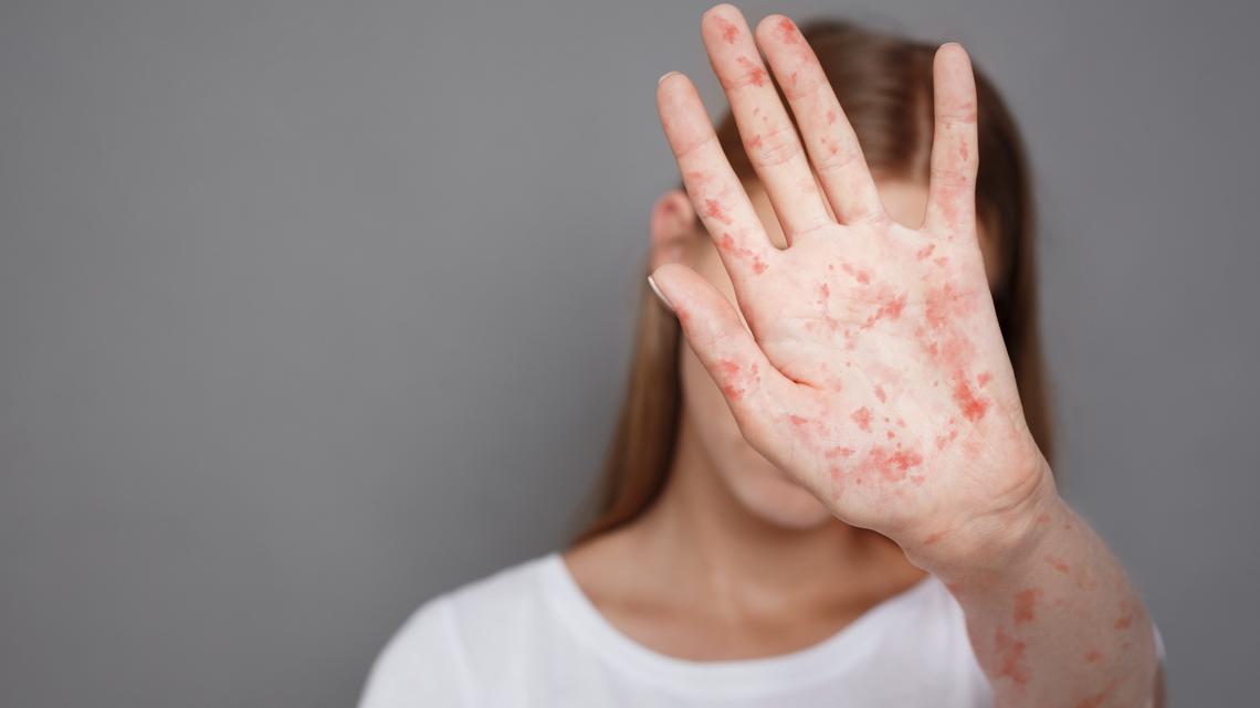 Child measles case reported in North Carolina, related to SC outbreak