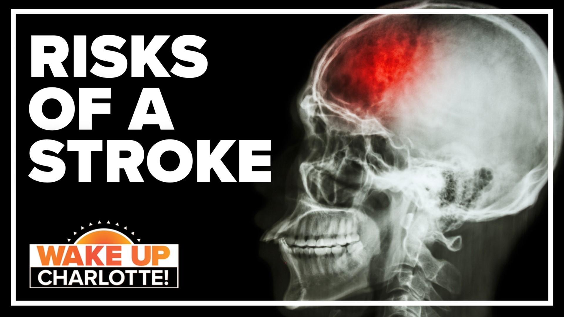 A Rise In People Having Strokes