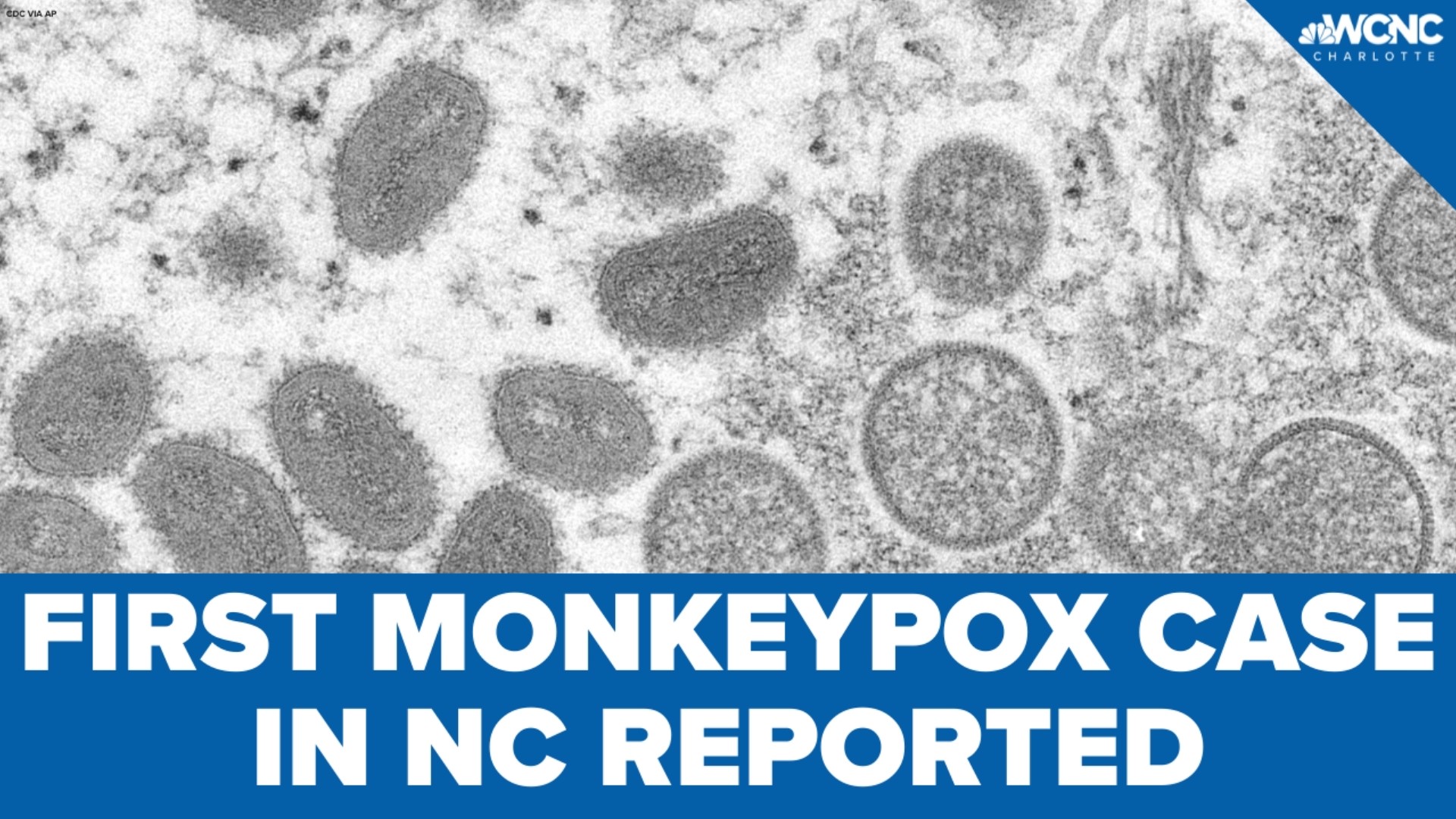 First case of monkeypox in NC