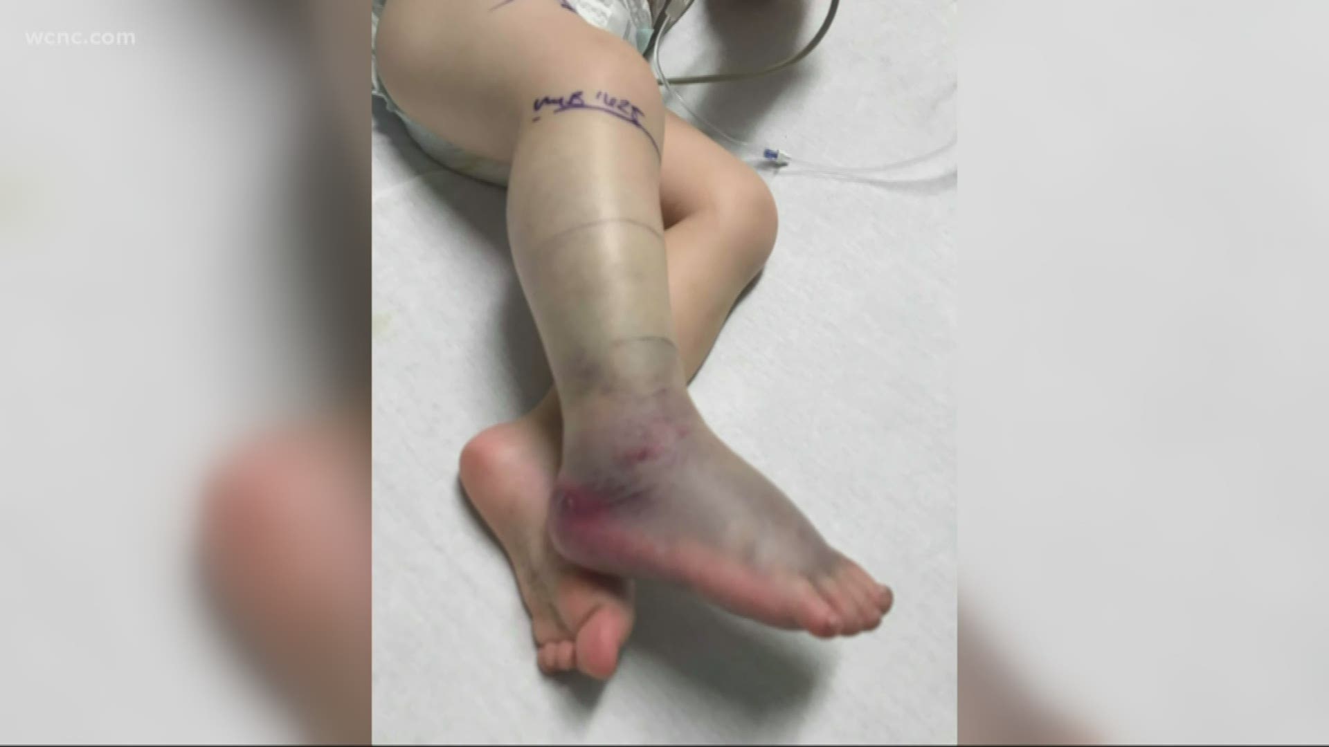A young boy in the Charleston area was rushed to the hospital after he was bitten while playing in the yard of his home. He was given anti-venom.