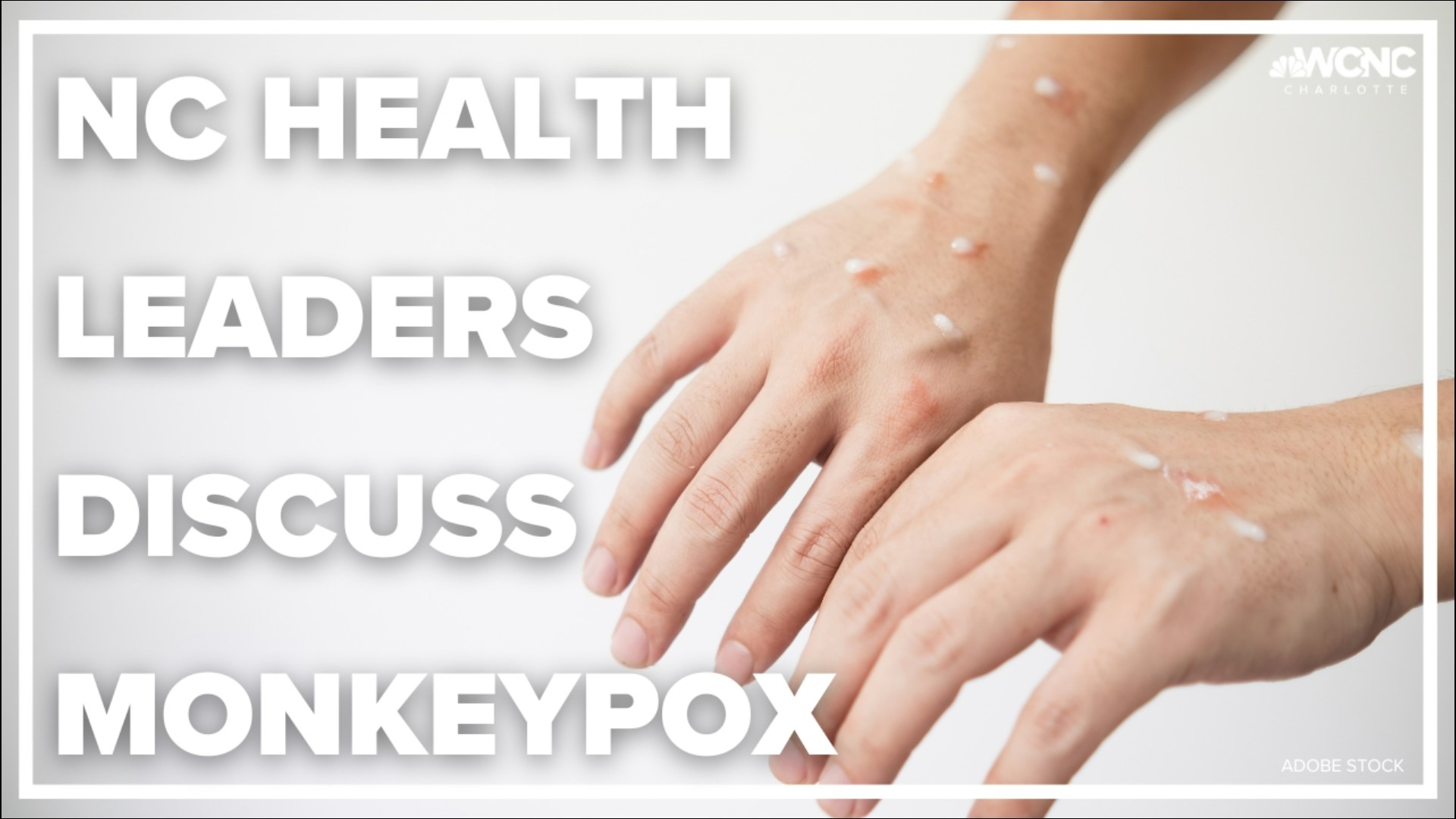 Health leaders calling on the community to help get the monkeypox outbreak under control.