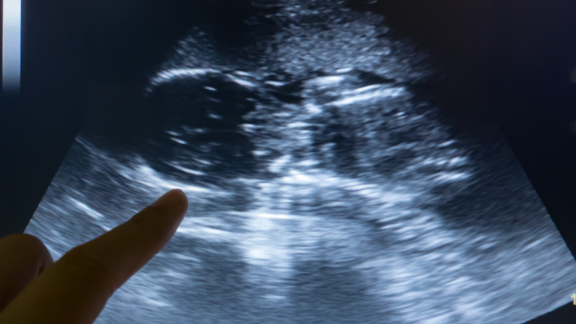 The bill outlaws abortions after a fetal heartbeat is detected.