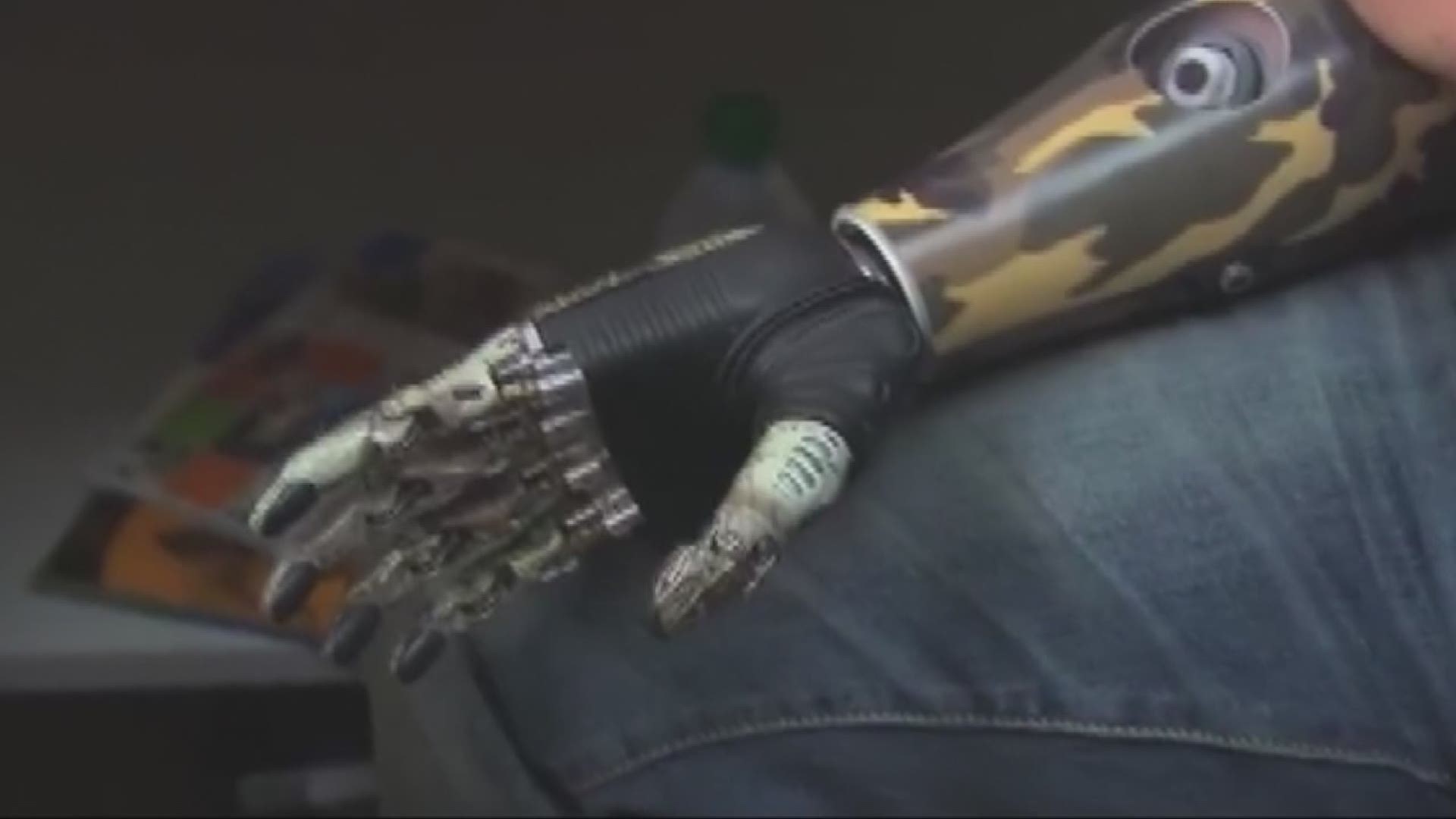 Mom bitten by shark getting high-tech prosthetic arm | wcnc.com