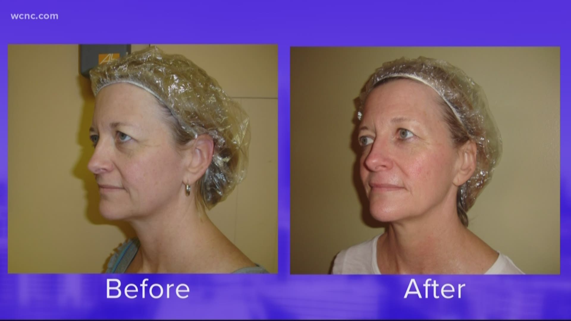 Beautiful Image Anti Aging can give you youthful skin with facial toning.