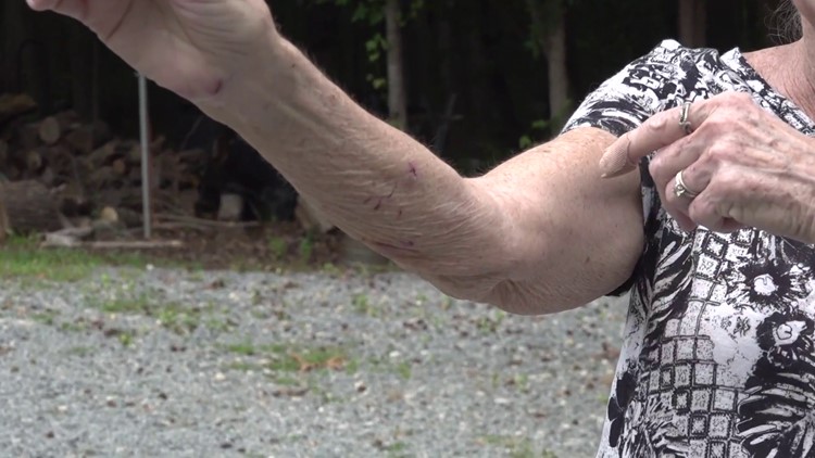 Union County couple describes vicious rabid fox attack: 'I could not get it off me'