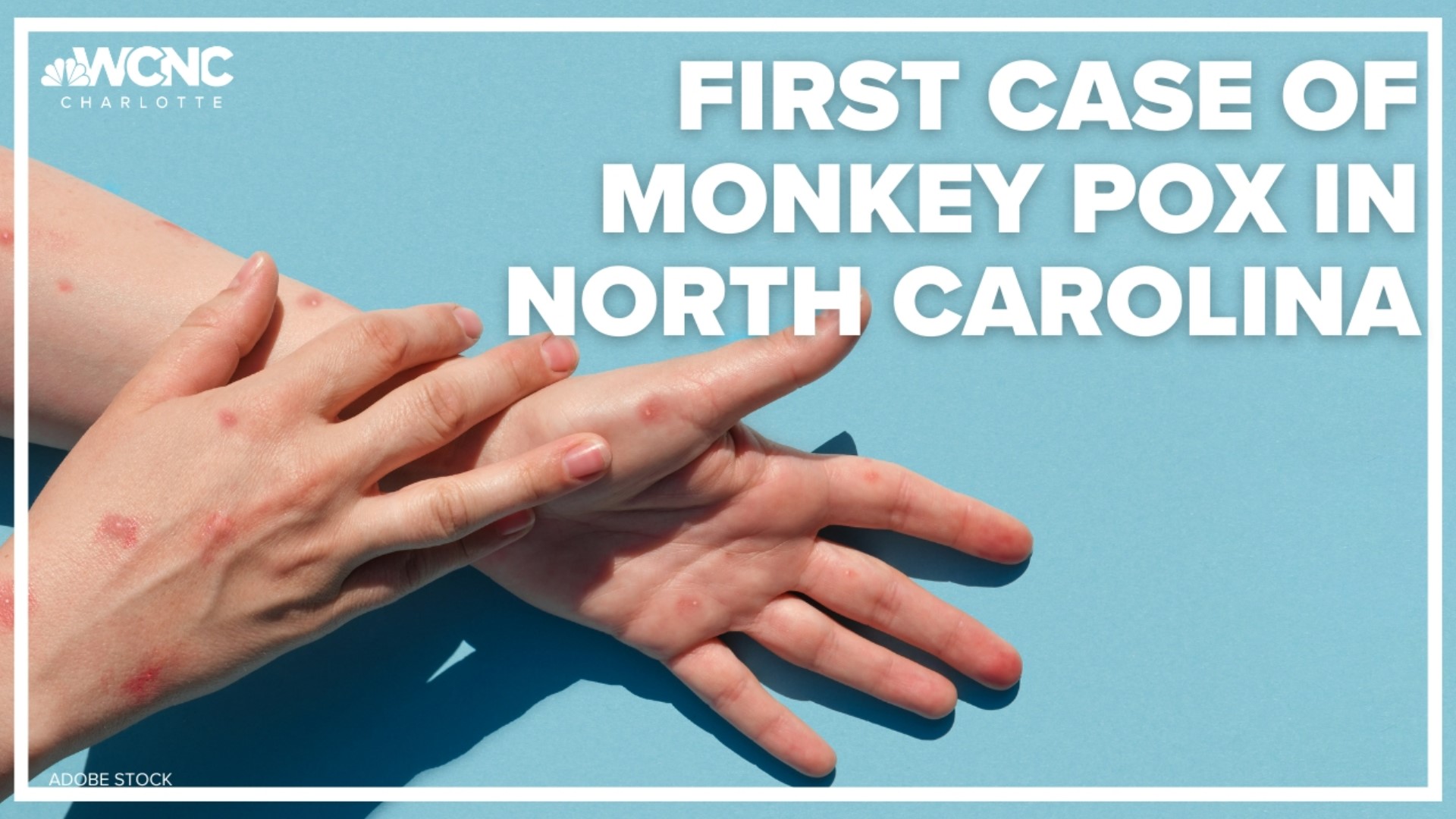 The State Department of Health and Human Services reports first case of Monkeypox in North Carolina today.