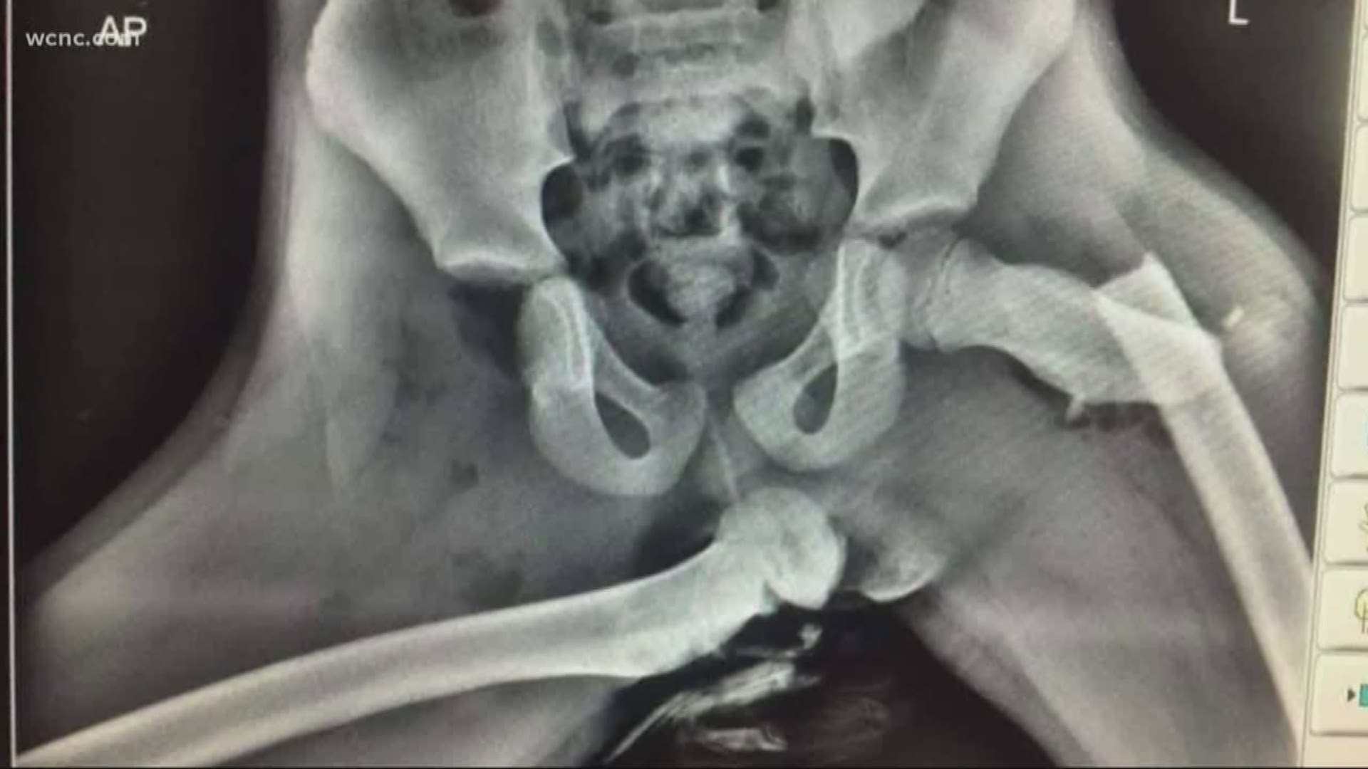 An x-ray photo is being shared showing the injuries doctors say a young woman suffered when she was a passenger involved in a crash.