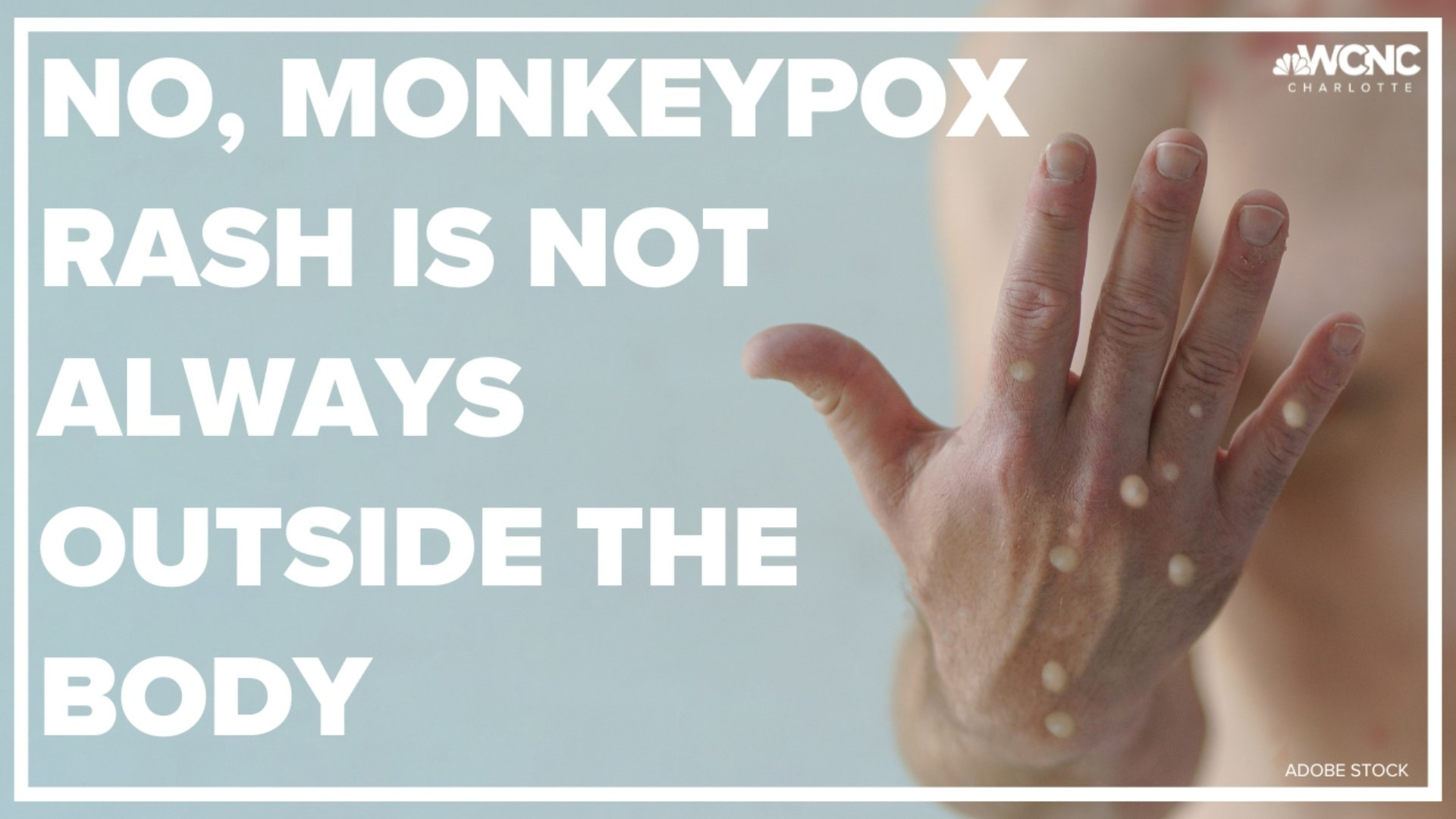 Many circulating photos of rashes from monkeypox infections show bumps and blisters on hands, legs, and faces. Doctors say that's not always where the rash emerges.