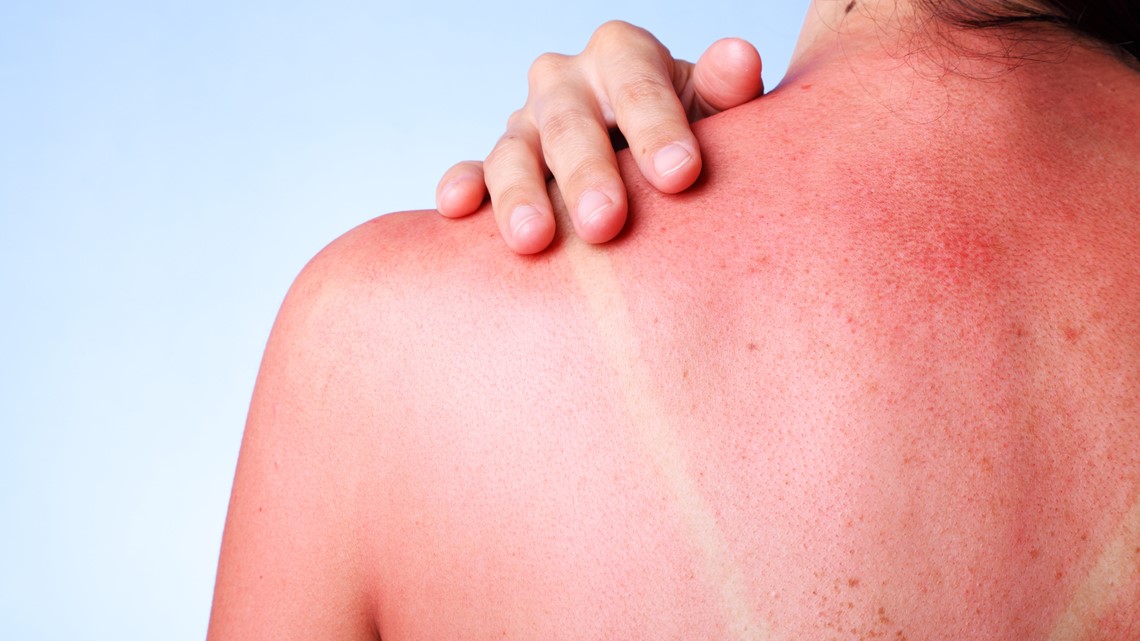 Can you get a sunburn when it