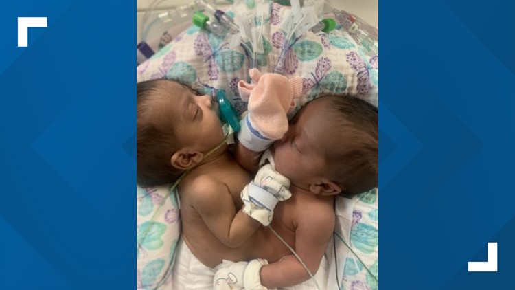 Texas hospital celebrates historic surgery separating conjoined twins