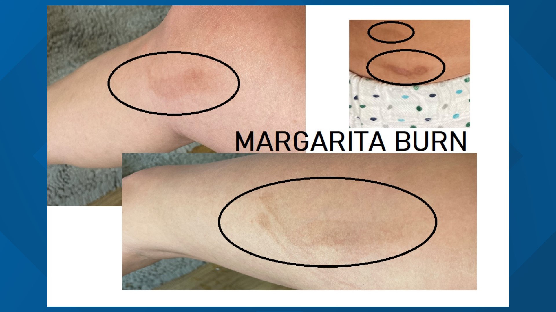 Margarita Burn is a real condition