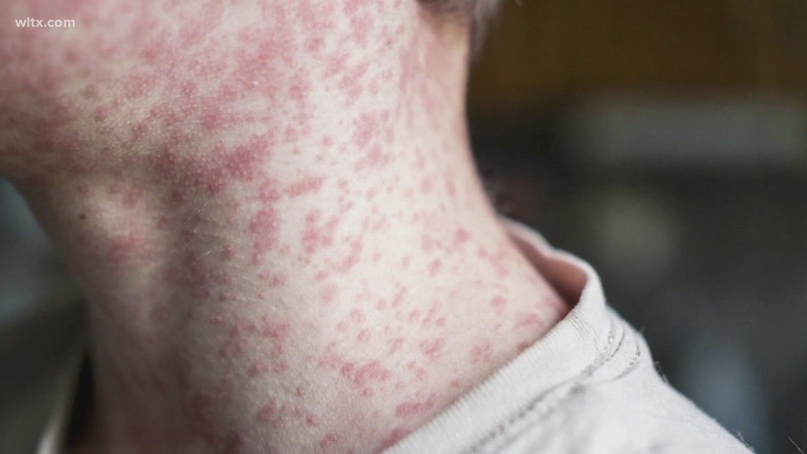 South Carolina measles outbreak rises to 25 cases in Spartanburg County