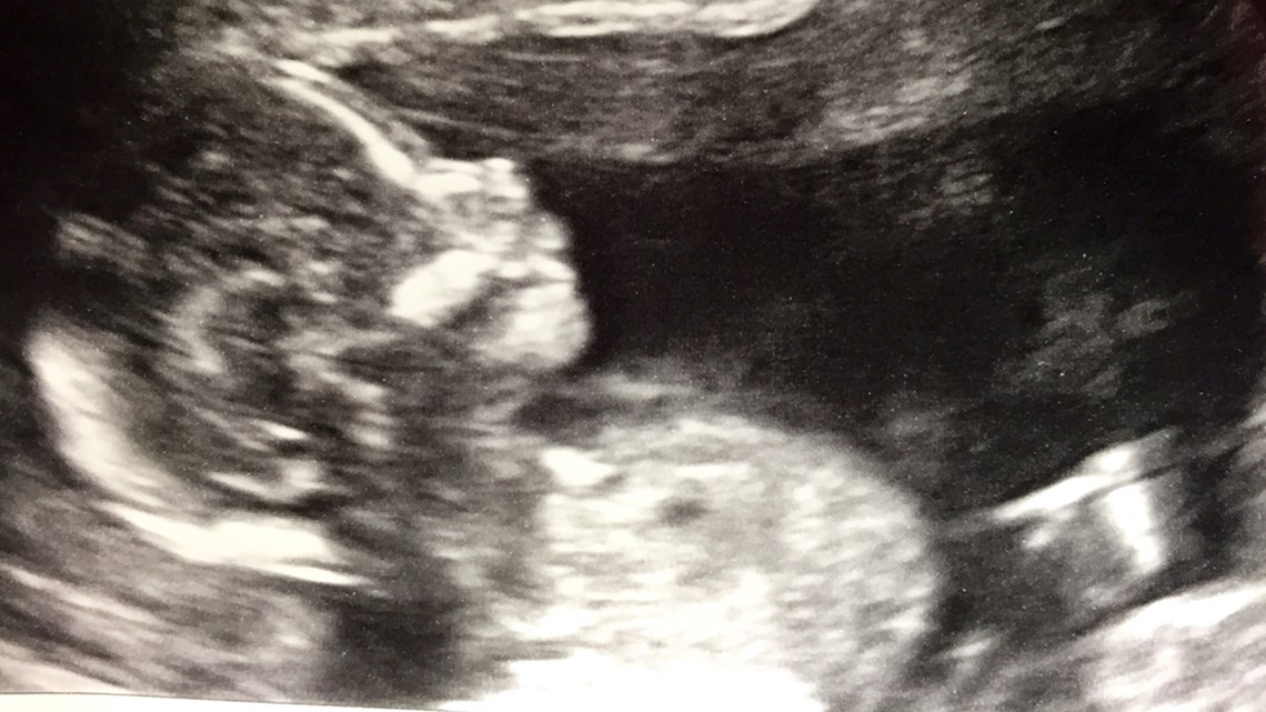 Richmond teen surprised with demon baby ultrasound | wcnc.com